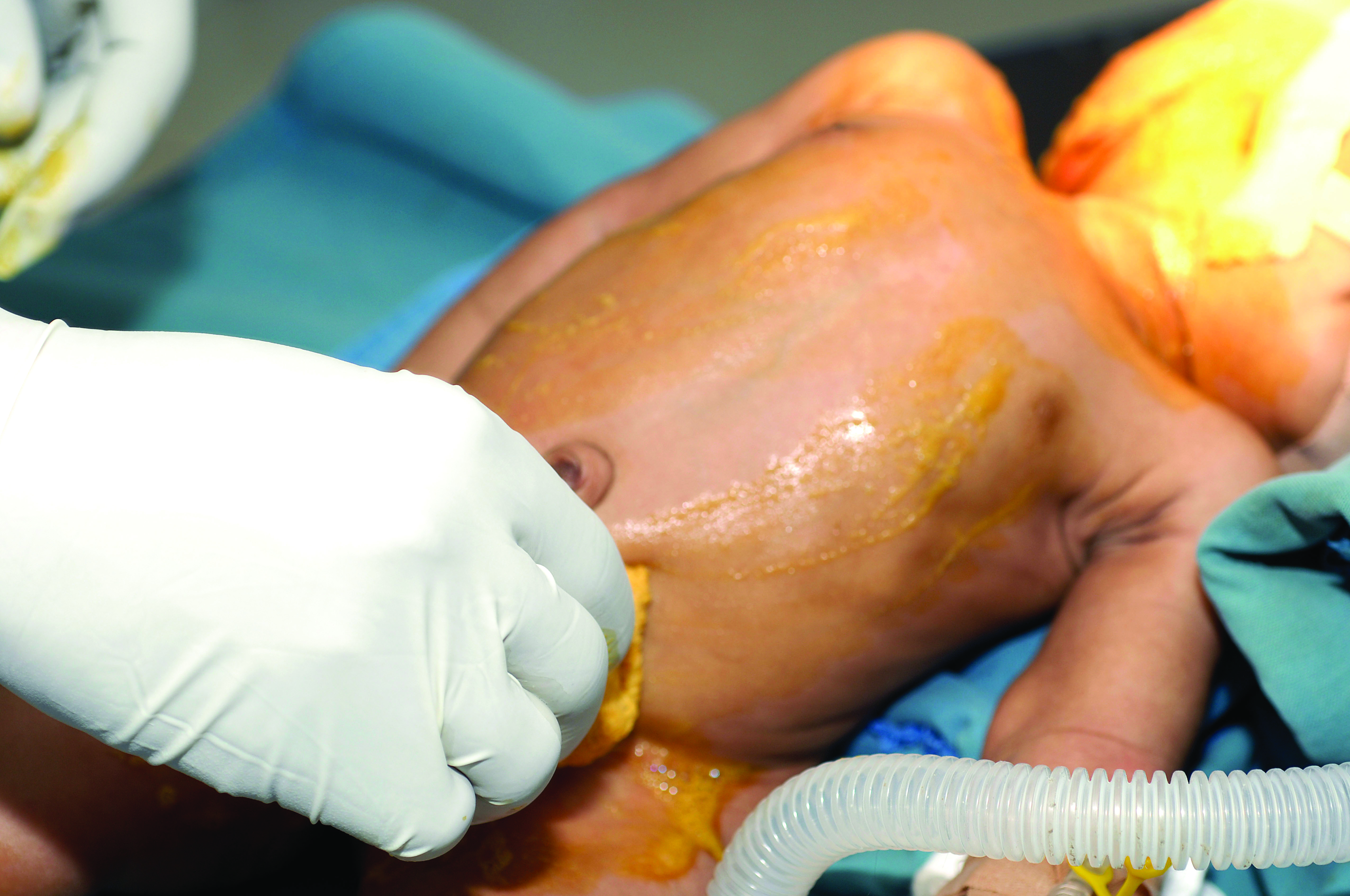 Methods Of Skin Antisepsis For Preventing Ssis Nursing Times