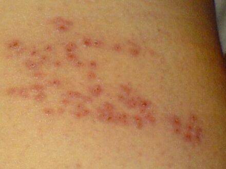 Public Health Experts Call For Expansion Of Shingles Vaccination Nursing Times