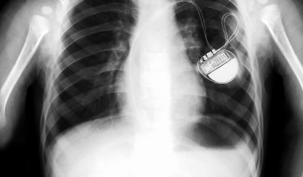 South Asian people may be at less risk of bradycardia than white patients