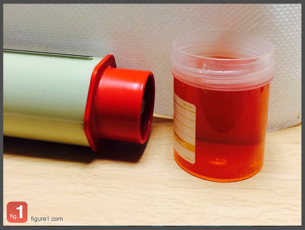 Beeturia Nursing Times