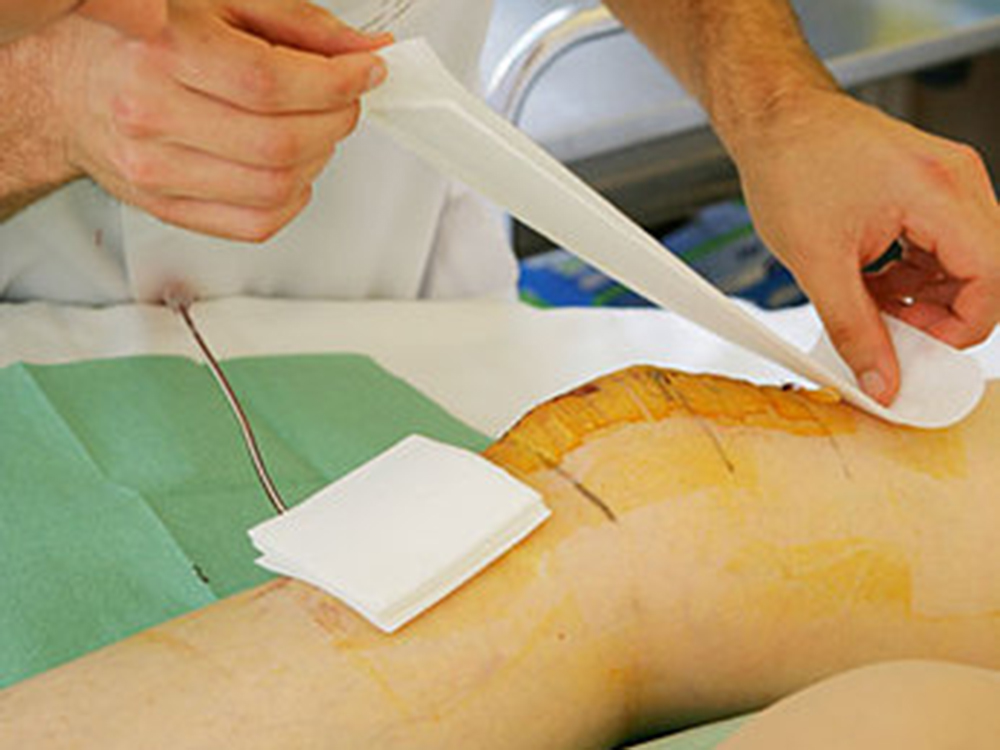 Can Wound Dressings Prevent Surgical Site Infection Nursing Times