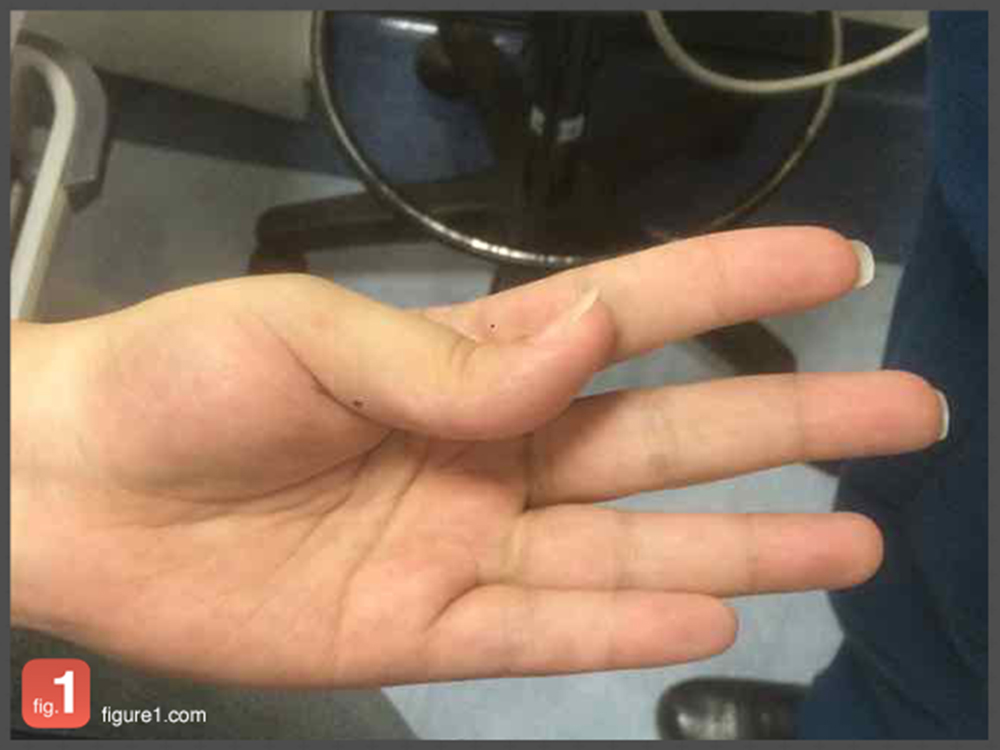Post Operative String. Sign Do You Recognise This Post-Operative Complication? | Nursing Times