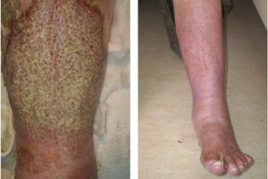 best aqueous cream for eczema