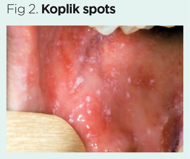 Preventing, identifying and managing measles outbreaks Nursing Times