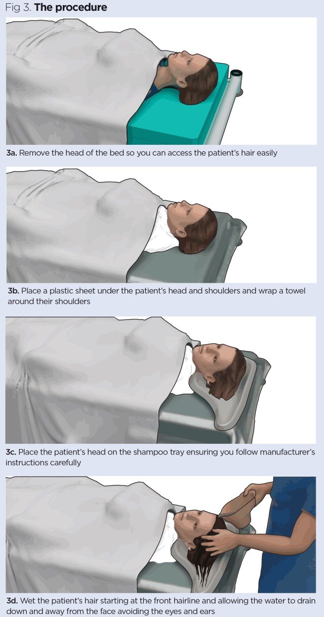 Procedure for washing patients' hair in 