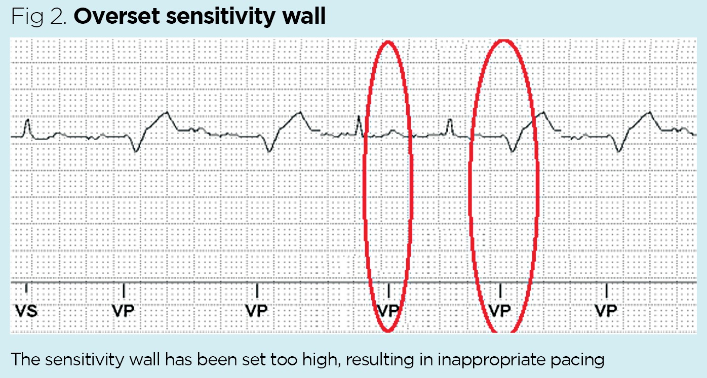 Pacemaker therapy 2 pacing functions and their role in patient care
