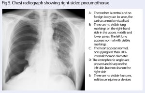 How to interpret chest radiographs (X-rays): a systematic approach ...