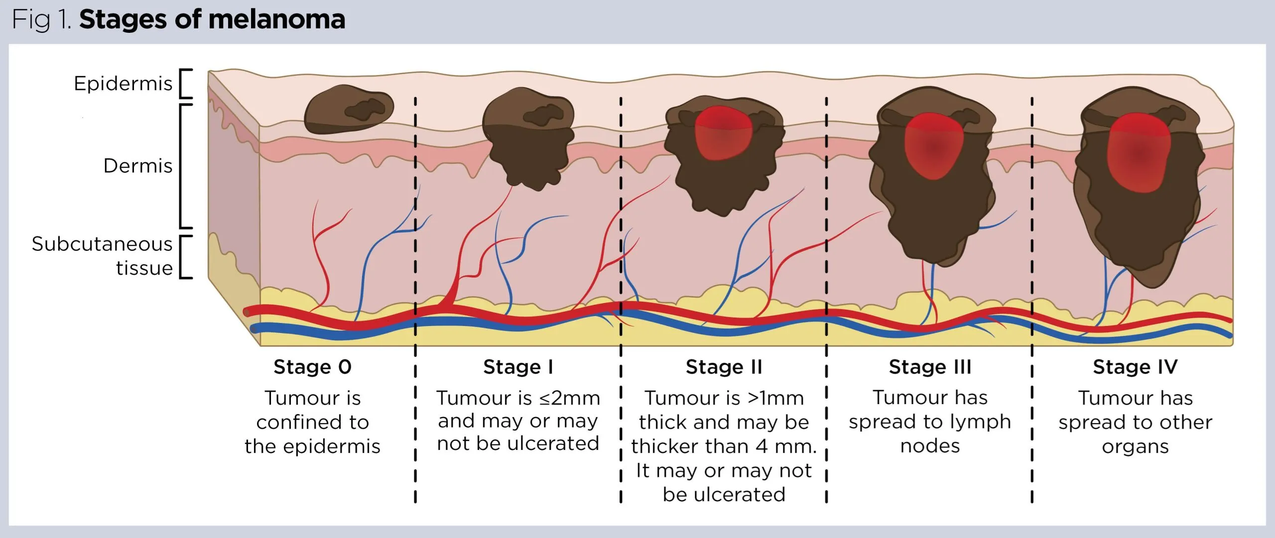 Stage 3 Malignant Melanoma