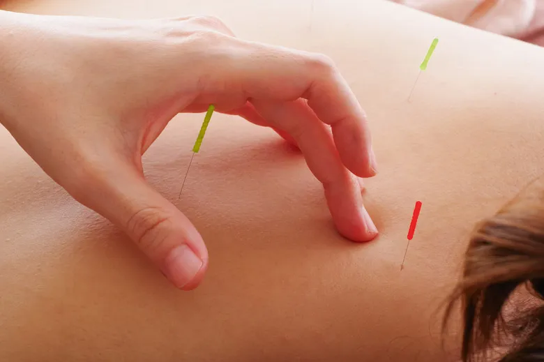 Medical acupuncture in healthcare: nurse perspectives and implementation