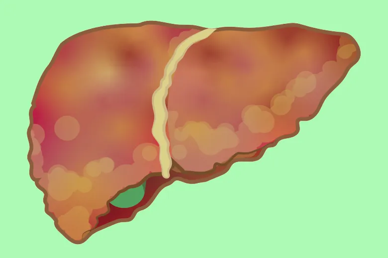 Understanding the main causes of chronic liver disease
